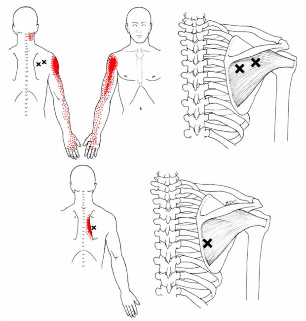 脊下肌與小圓肌的激痛點參考位置，紅色區域為傳導痛的位置