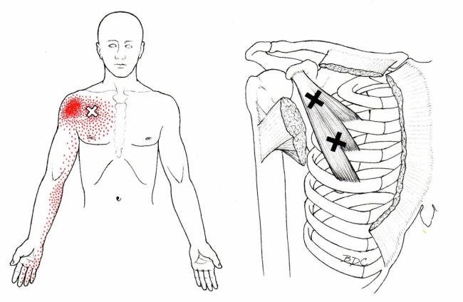 胸小肌的激痛點參考位置，紅色區域為傳導痛的位置