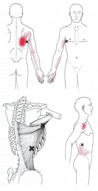 闊背肌的激痛點參考位置，紅色區域為傳導痛的位置